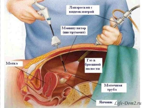 Причины и лечение внематочной беременности