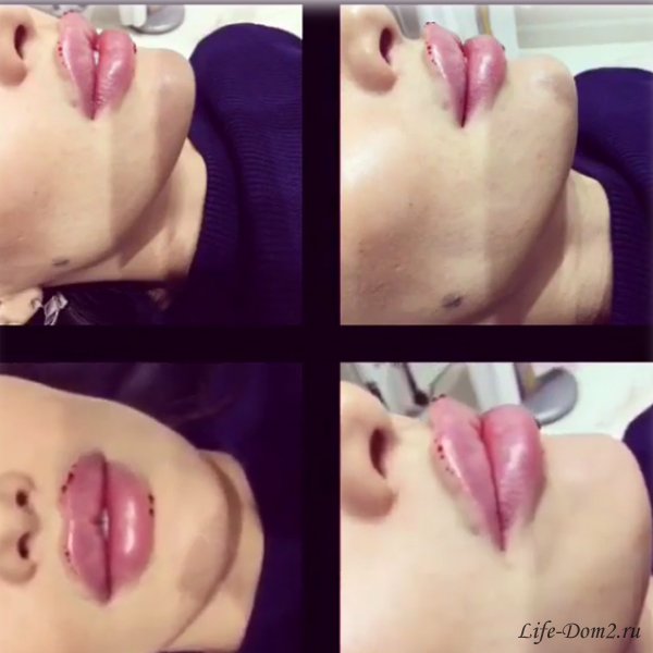 Элла Суханова испортила губы. Фото